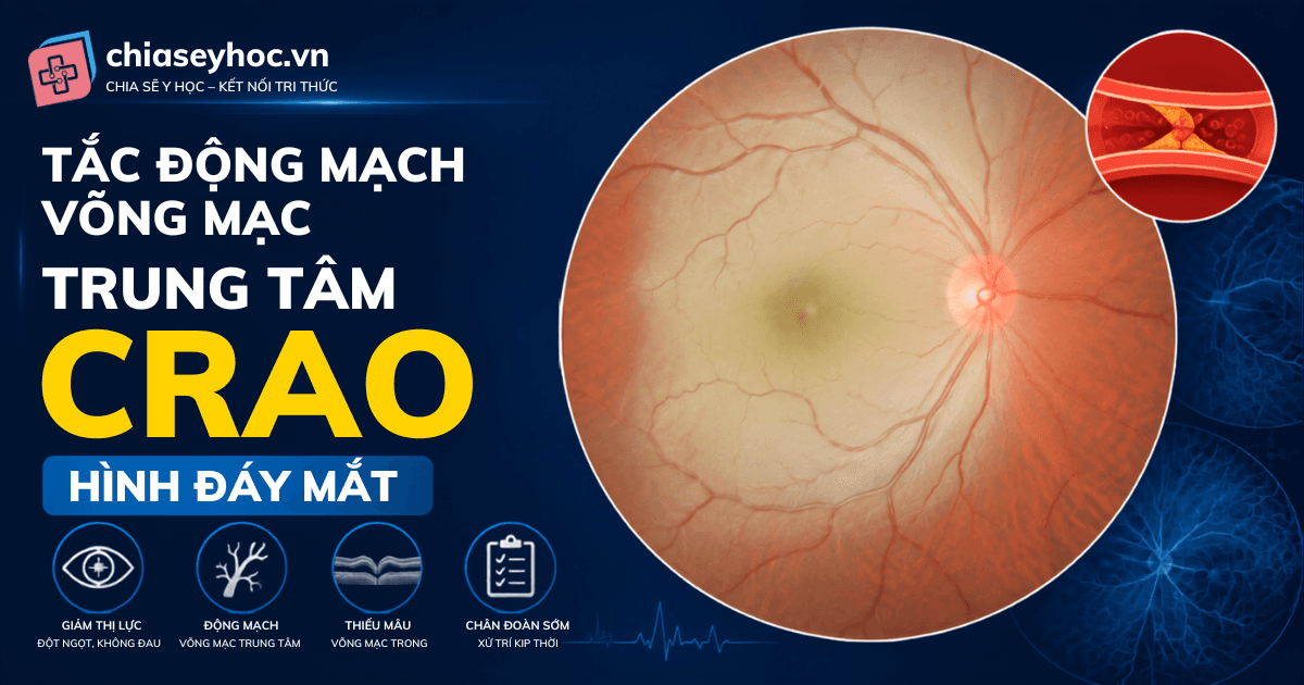 Tắc Động mạch Võng mạc Trung tâm (CRAO) : Đột quỵ mắt cần xử trí khẩn cấp