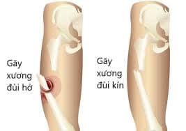 Gãy xương đùi