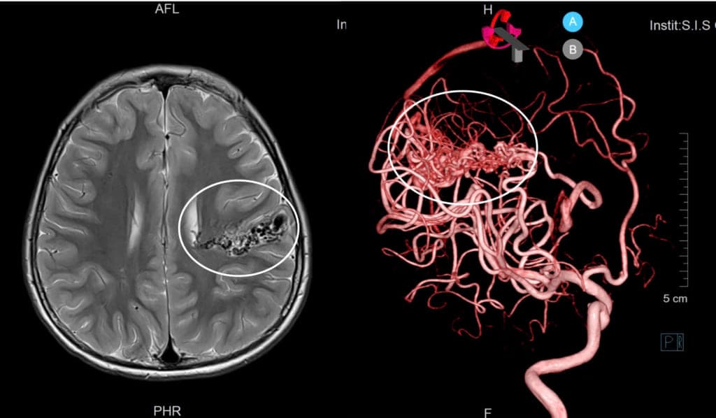 hình 2. AVM trên hình ảnh MRI