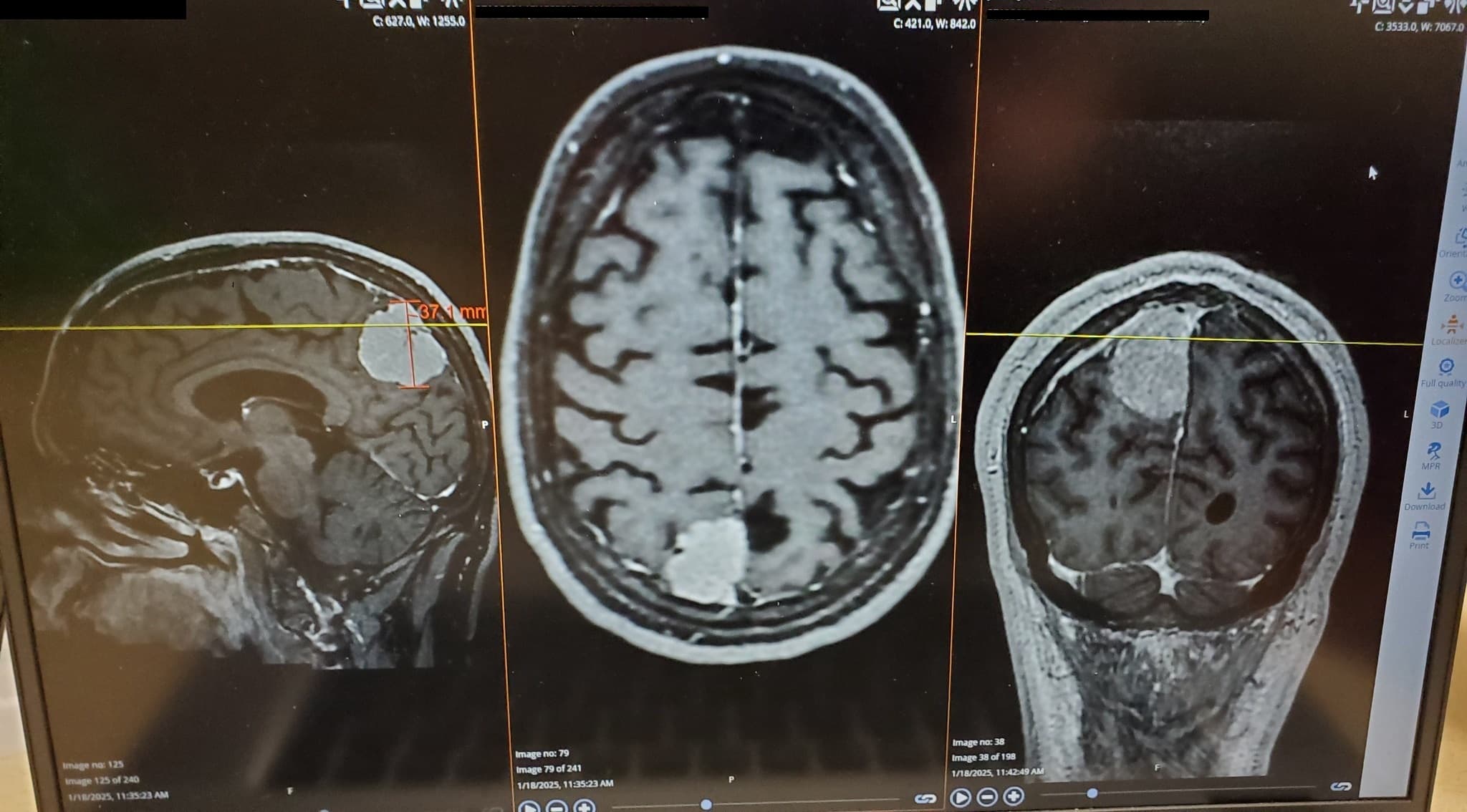 MRI não với gadolinium — khối u não bắt thuốc dạng vòng điển hình. Nguồn: Wikimedia Commons, CC BY-SA 4.0