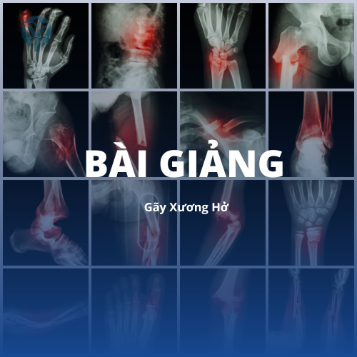 Gãy xương hở